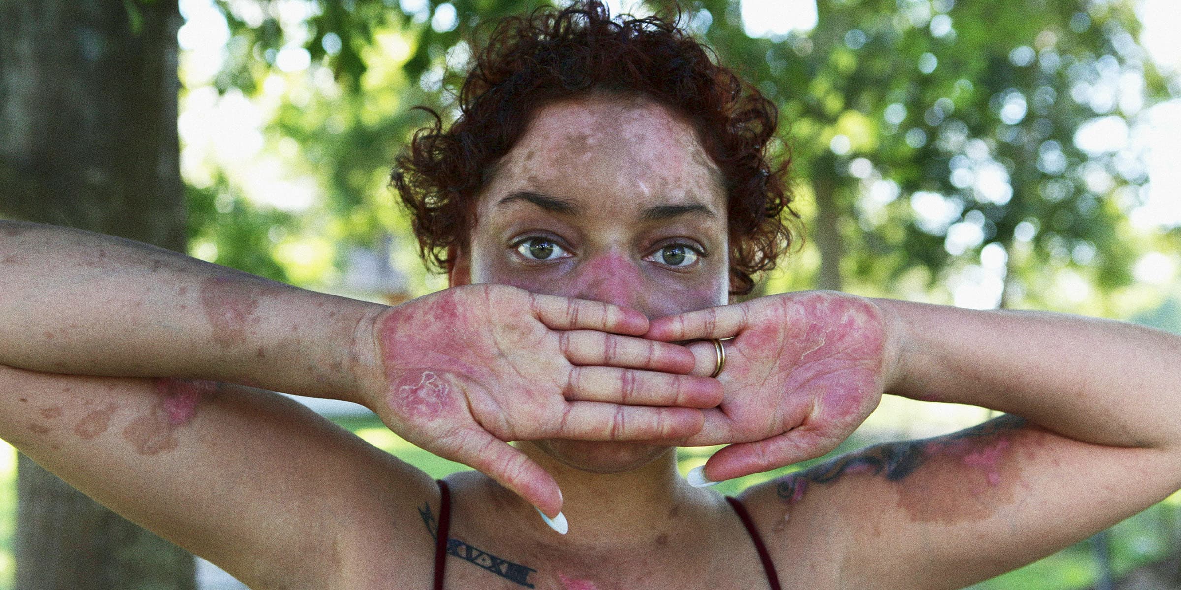 Person with skin condition outdoors.