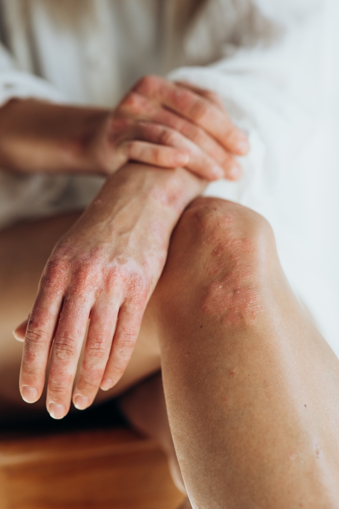 Skin condition on hands and knees